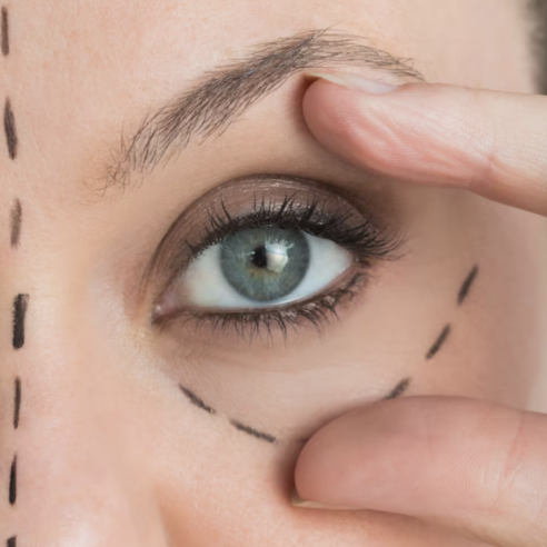 Traçage préopératoire sur la paupière avant blépharoplastie en Tunisie