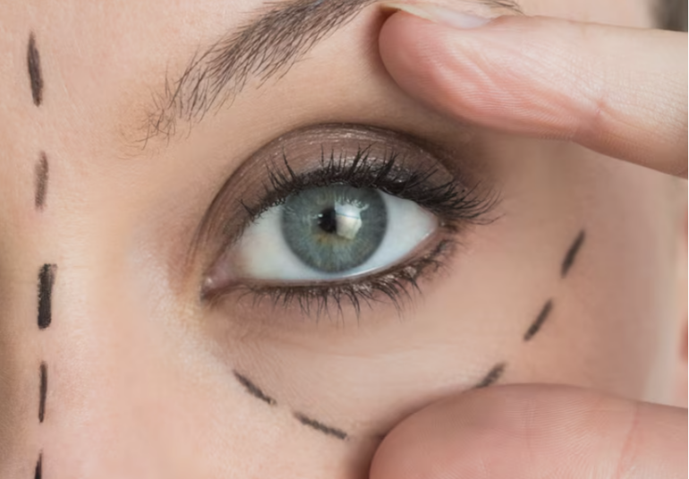 Traçage préopératoire sur la paupière avant blépharoplastie en Tunisie