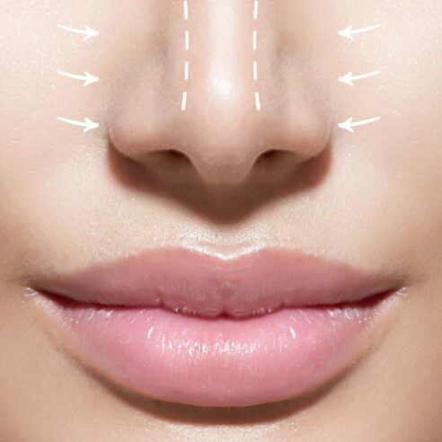 la Rhinoplastie : affiner le nez