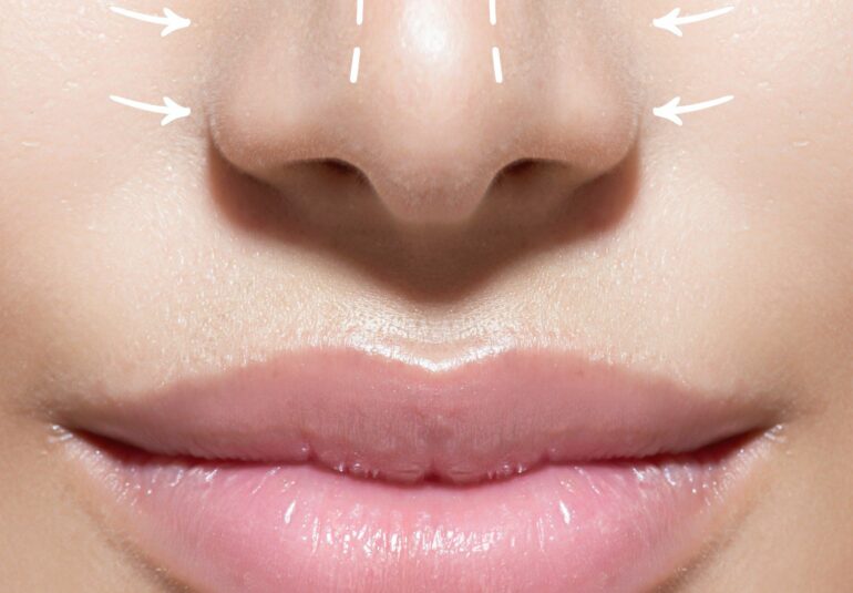 la Rhinoplastie : affiner le nez