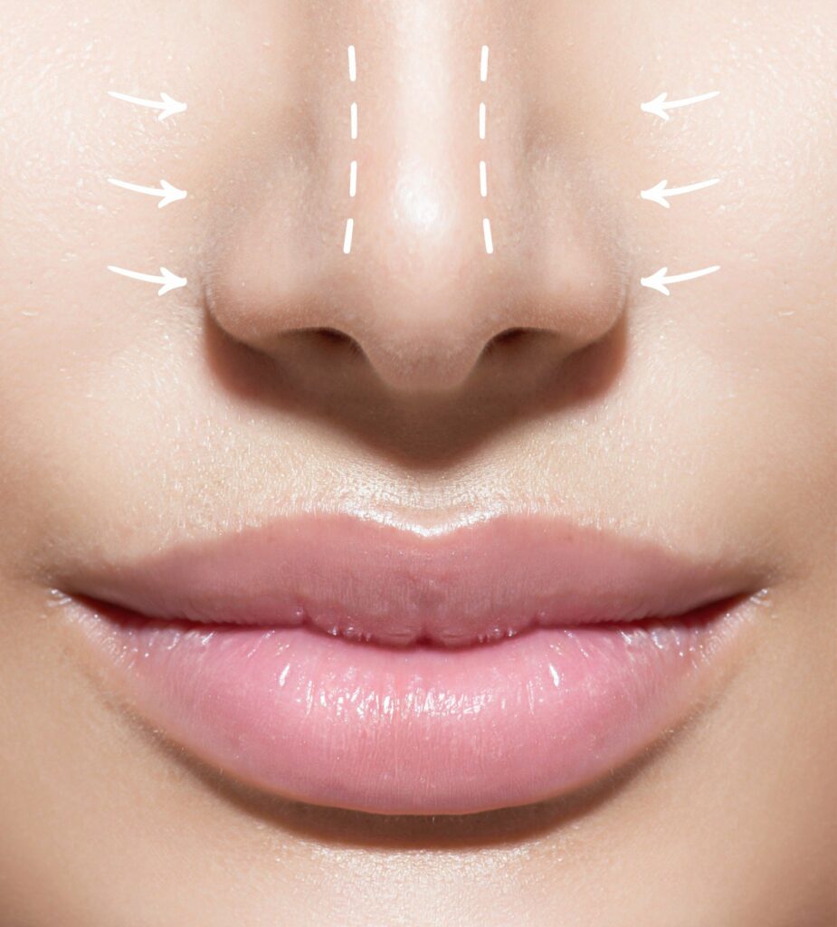 la Rhinoplastie : affiner le nez