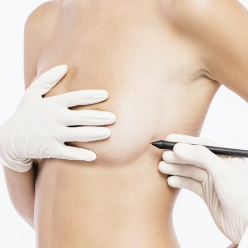 Chirurgie mammaire : Réduction mammaire Tunisie