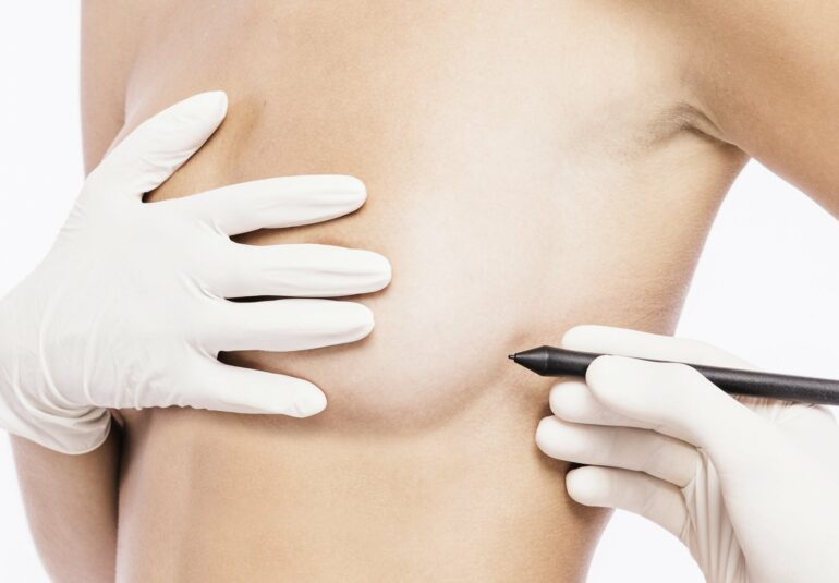 Chirurgie mammaire : Réduction mammaire Tunisie