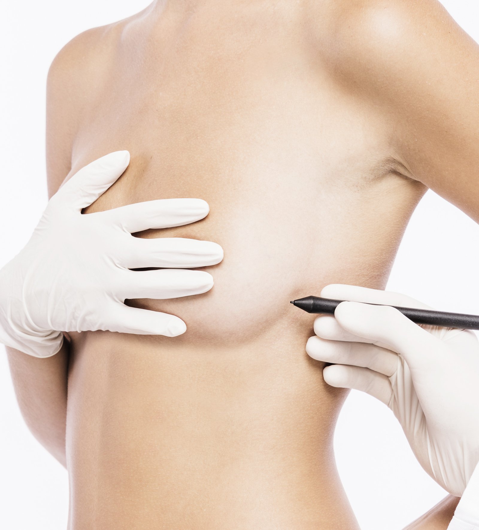Chirurgie mammaire : Réduction mammaire Tunisie