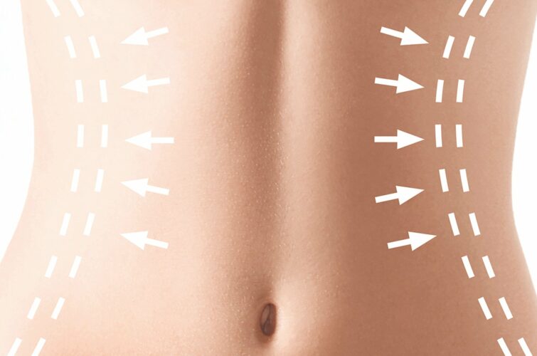 abdominoplastie 1 an après