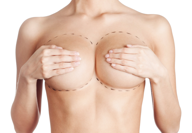 Résultat naturel d'une chirurgie mammaire en Tunisie : augmentation et lifting mammaire pour une silhouette féminine harmonieuse