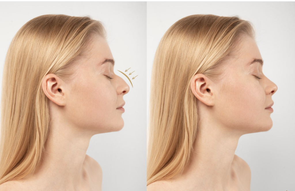 Avant et après rhinoplastie – chirurgie esthétique du nez en Tunisie avec Silhouette Esthetics