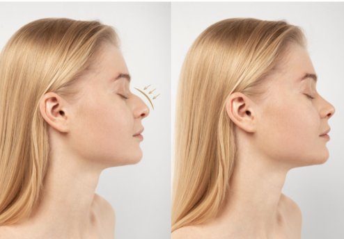 Avant et après rhinoplastie – chirurgie esthétique du nez en Tunisie avec Silhouette Esthetics