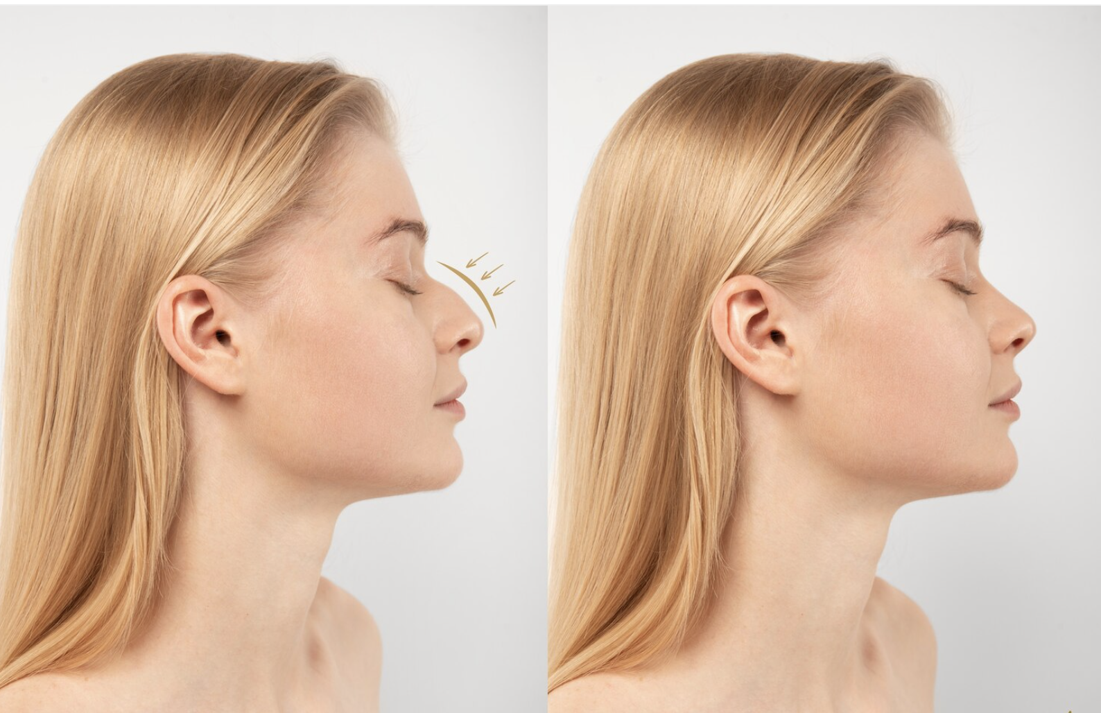 Avant et après rhinoplastie – chirurgie esthétique du nez en Tunisie avec Silhouette Esthetics