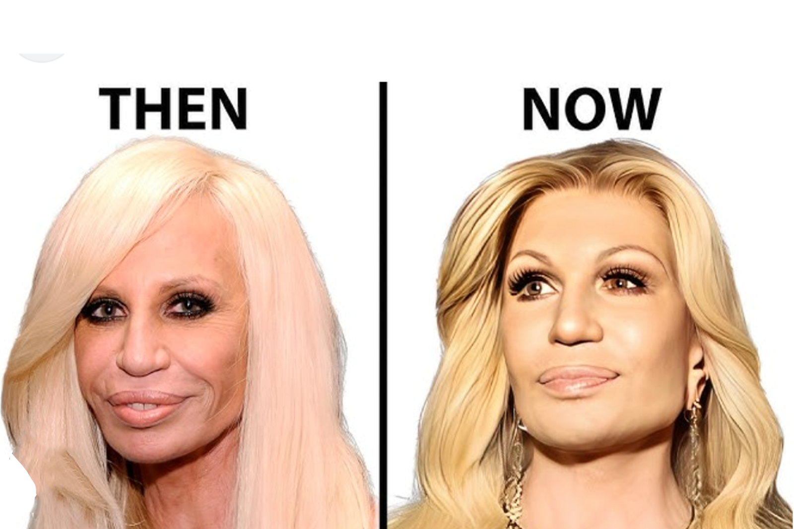 Transformation avant/après du visage de Donatella Versace après son lifting réussi – résultat naturel et élégant à 69 ans