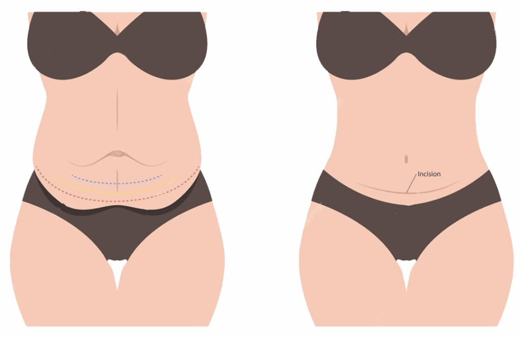 "abdominoplastie Avant et Après , Réslutat illustré "