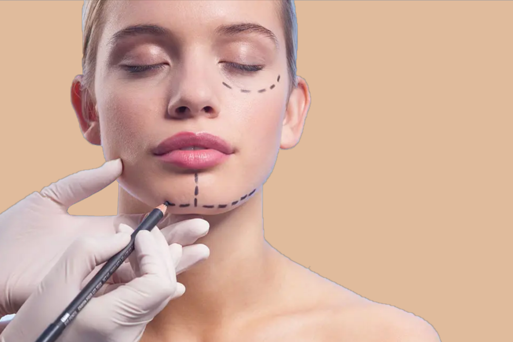 Séjour esthétique en Tunisie : visage féminin avec traçage pré-opératoire pour chirurgie esthétique
