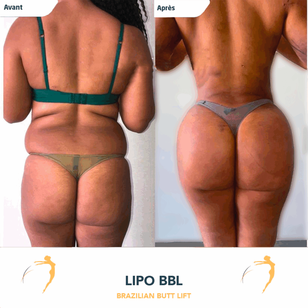 Résultat avant et après d’un lipofilling des fesses en Tunisie avec taille affinée et fesses galbées"