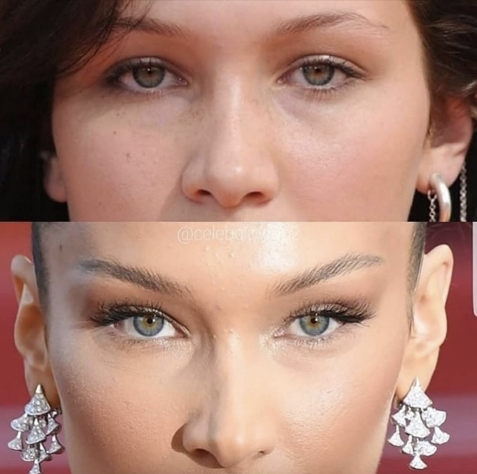 Canthopexie avant et après : Bella Hadid