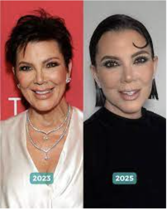 lifting visage de kris jenner avant après