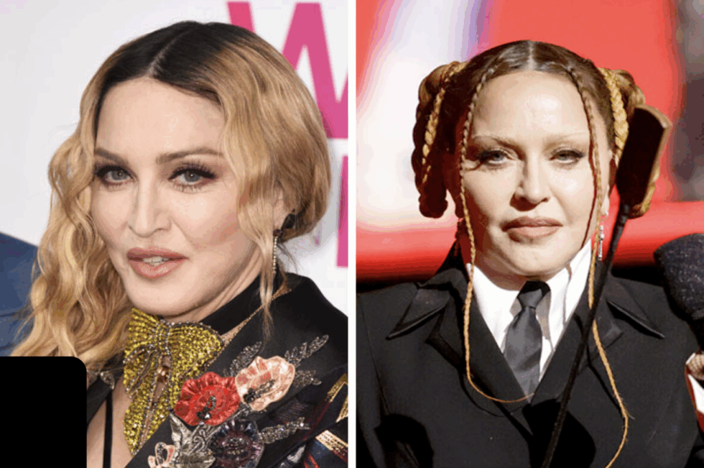 Madonna : Filler Fatigue - excès d'injection de filler