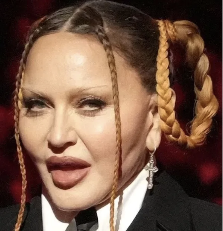 Madonna Visage Gonflé - un excès d'injection produits de comblement