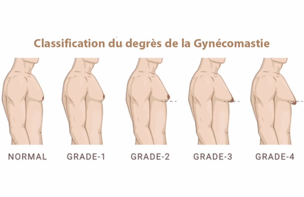 Gynécomastie-chirurgie masculine