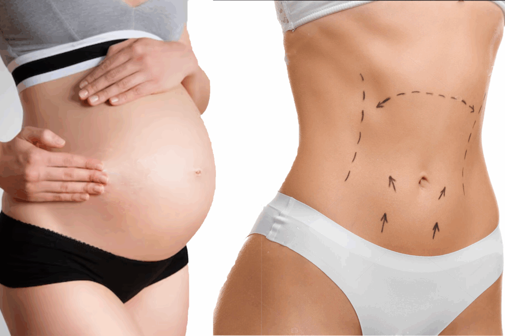 Résultat d’une abdominoplastie après grossesse avec correction du diastasis et peau retendue.