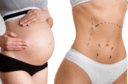 Résultat d’une abdominoplastie après grossesse avec correction du diastasis et peau retendue.