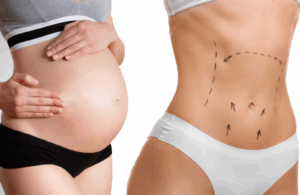 Résultat d’une abdominoplastie après grossesse avec correction du diastasis et peau retendue.