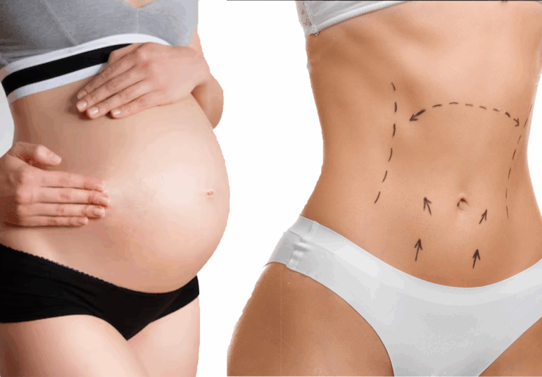 Résultat d’une abdominoplastie après grossesse avec correction du diastasis et peau retendue.