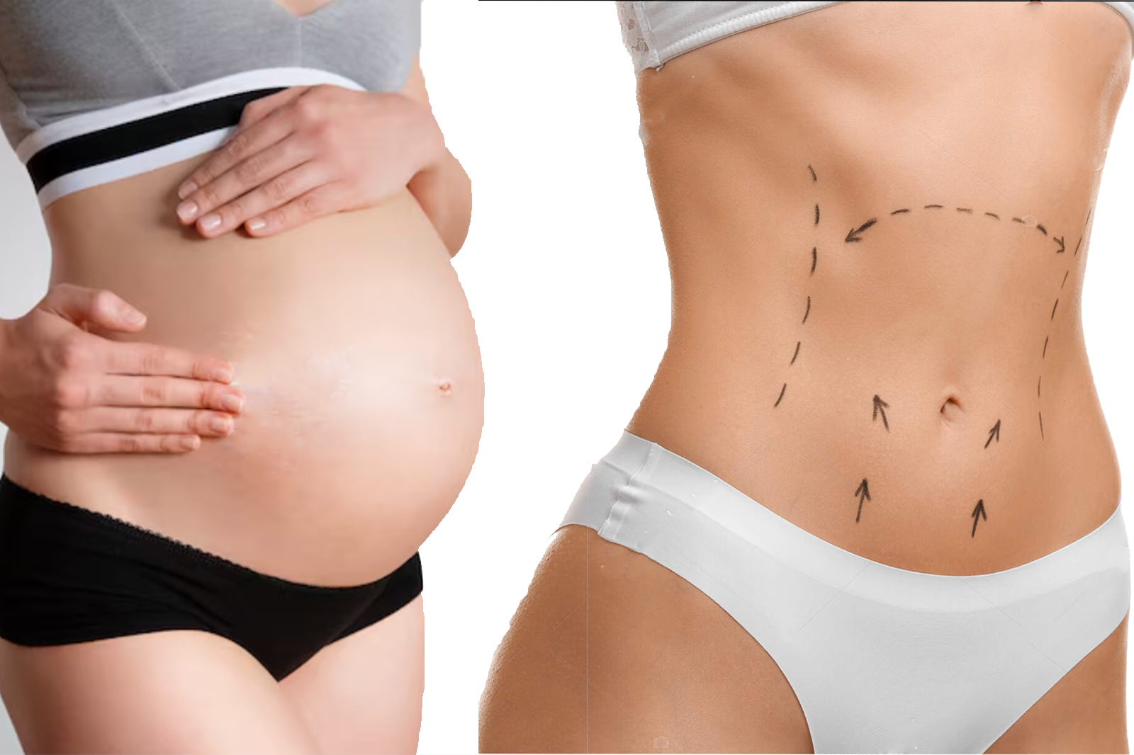 Résultat d’une abdominoplastie après grossesse avec correction du diastasis et peau retendue.