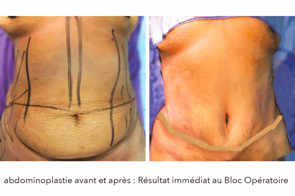 Abdominoplastie avant et après, résultat immédiat au bloc opératoire sur une patiente
