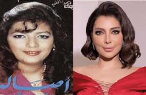 lifing du visage : Assala Nasri Avant et Après