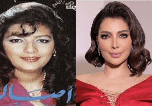 lifing du visage : Assala Nasri Avant et Après