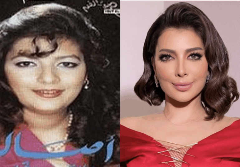 lifing du visage : Assala Nasri Avant et Après