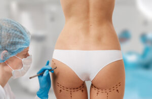 Chirurgie bbl : augmentation des fesses