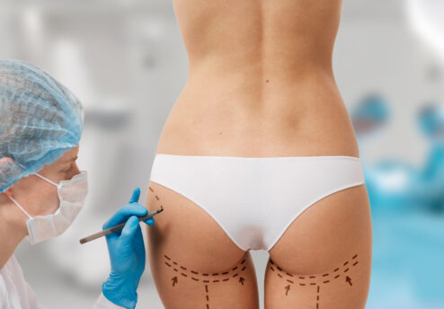 Chirurgie bbl : augmentation des fesses