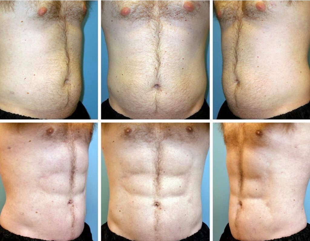 etching abdominal en Tunisie avant et après