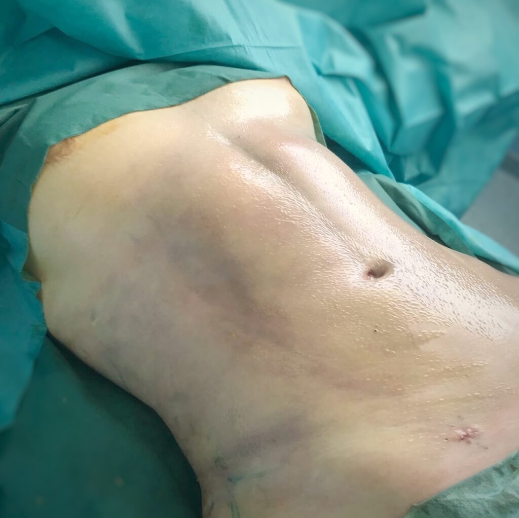 Résultat immédiat d'un etching abdominal au bloc opératoire