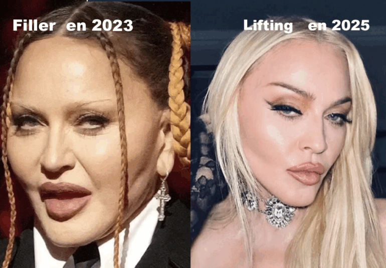 Madonna avant et apres