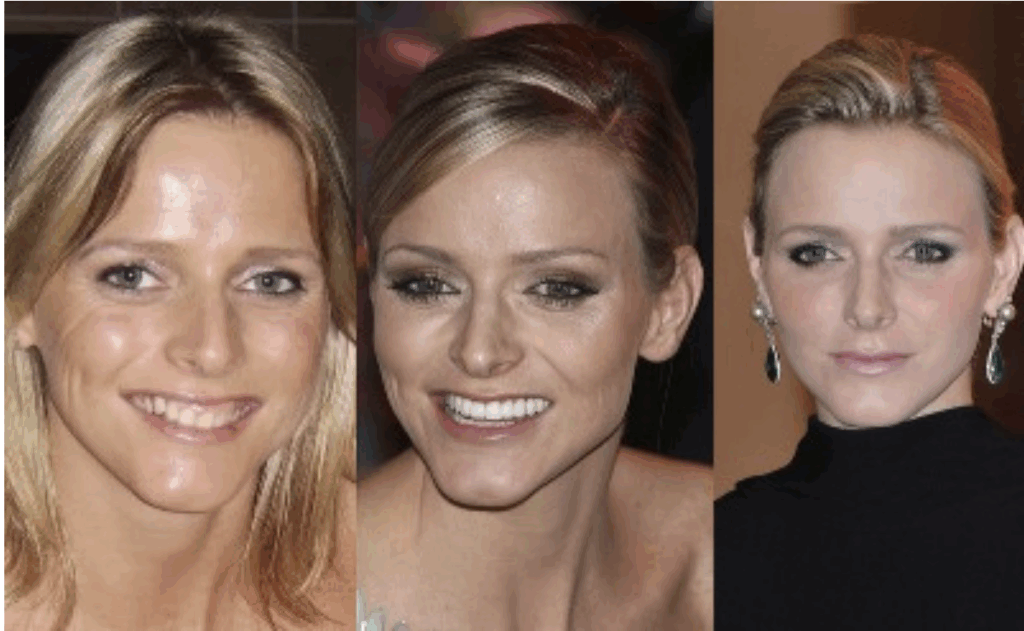 Comparaison du visage de Charlène de Monaco avant et après ses transformations esthétiques

