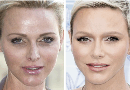 Charlène de Monaco avant et après chirurgie esthétique – évolution du visage