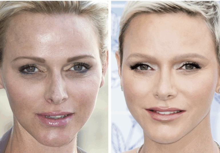 Charlène de Monaco avant et après chirurgie esthétique – évolution du visage