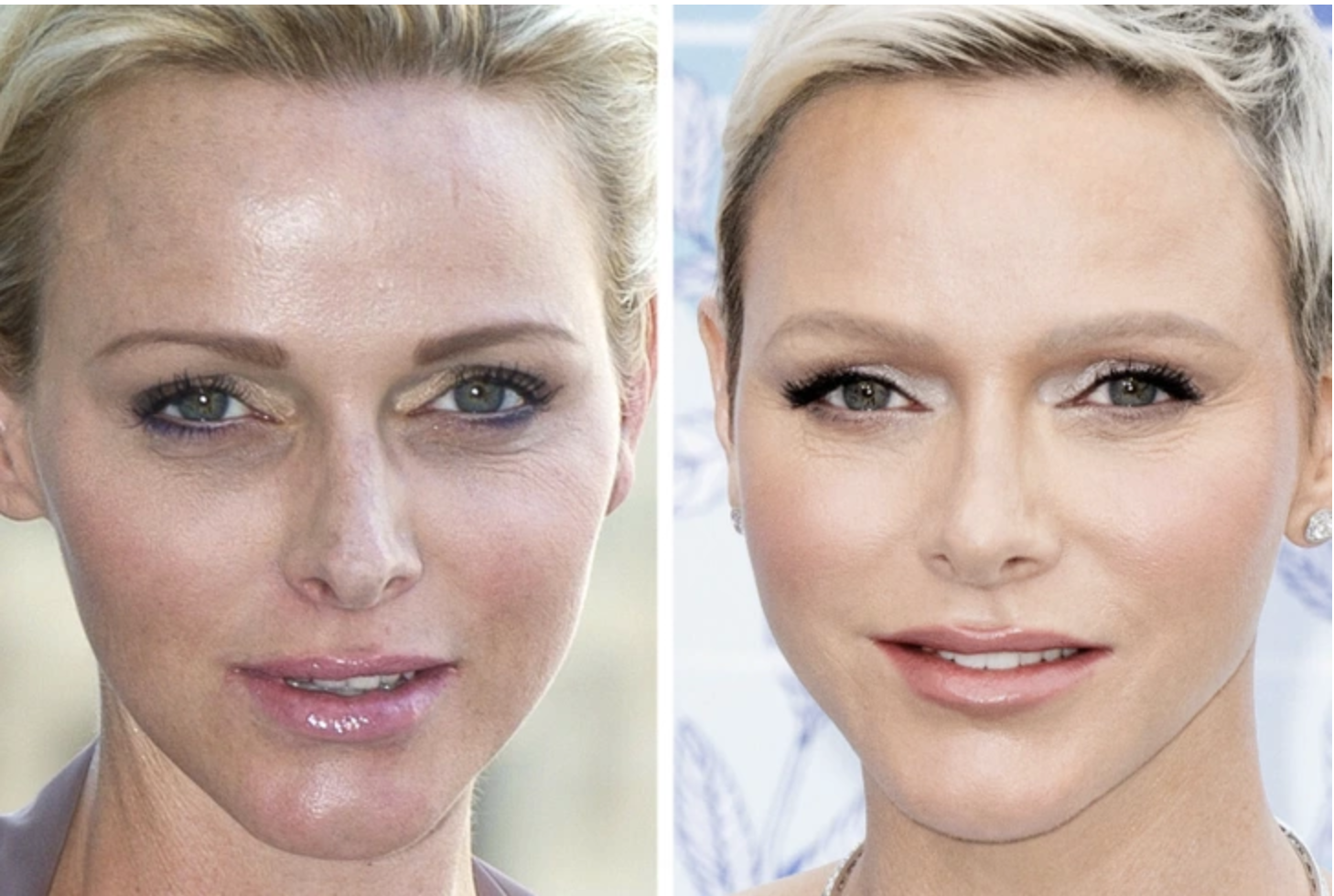Charlène de Monaco avant et après chirurgie esthétique – évolution du visage