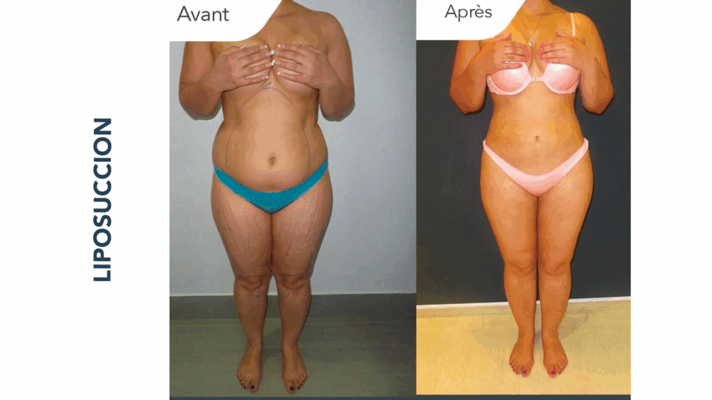 Résultat avant et après liposuccion complète ventre, hanches et cuisses – silhouette affinée après chirurgie esthétique en Tunisie
