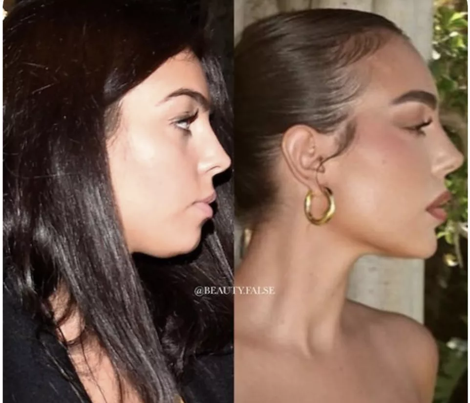 photos avant et après rhinoplastie de Georgina Rodriguez 