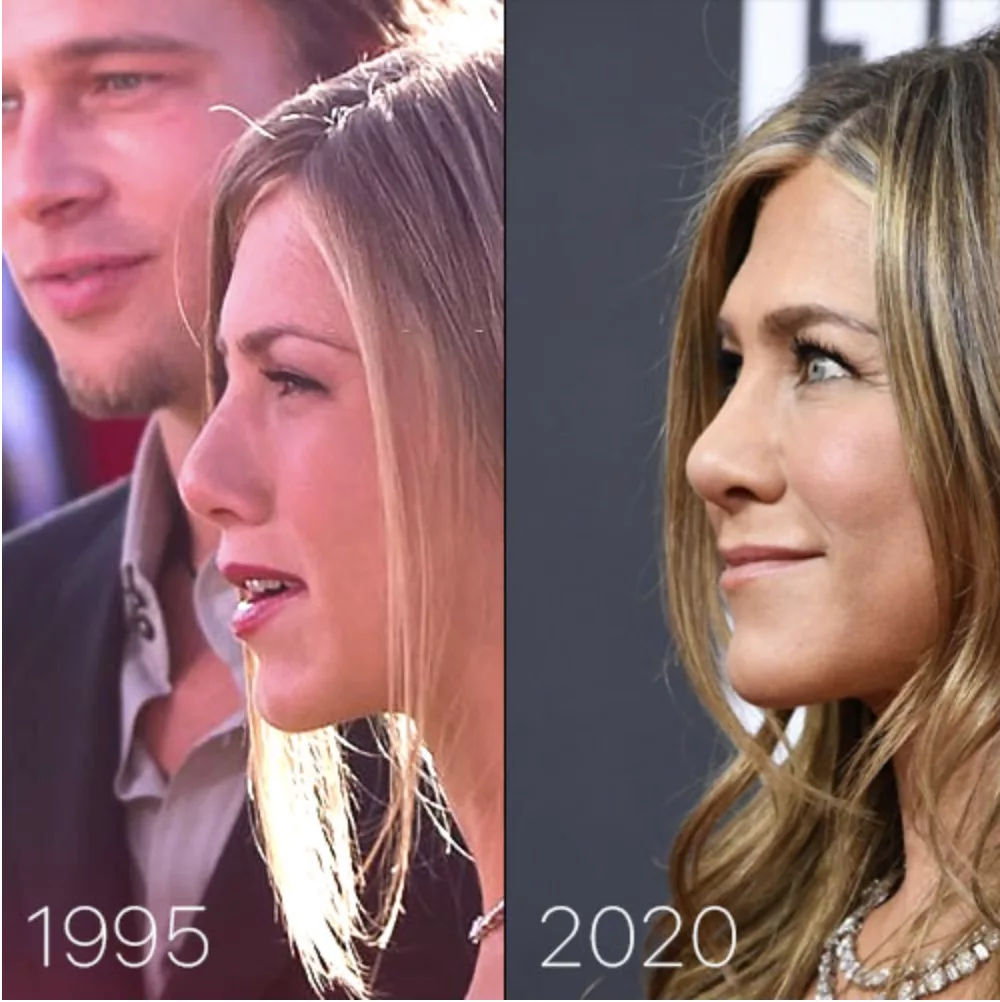 Photo de Jennifer Aniston avant et après la rhinoplastie