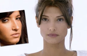 Mélanie Dedigama avant et après chirurgie esthétique