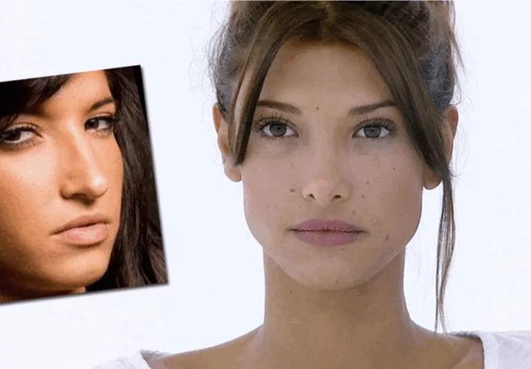 Mélanie Dedigama avant et après chirurgie esthétique