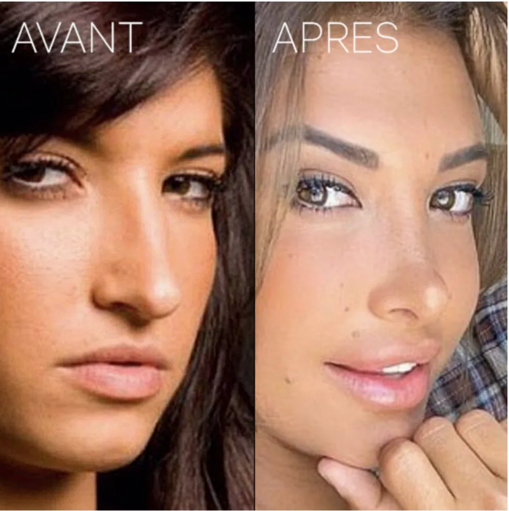 Mélanie Dedigama  avant et après Rhinoplastie (chirurgie esthétique du nez )