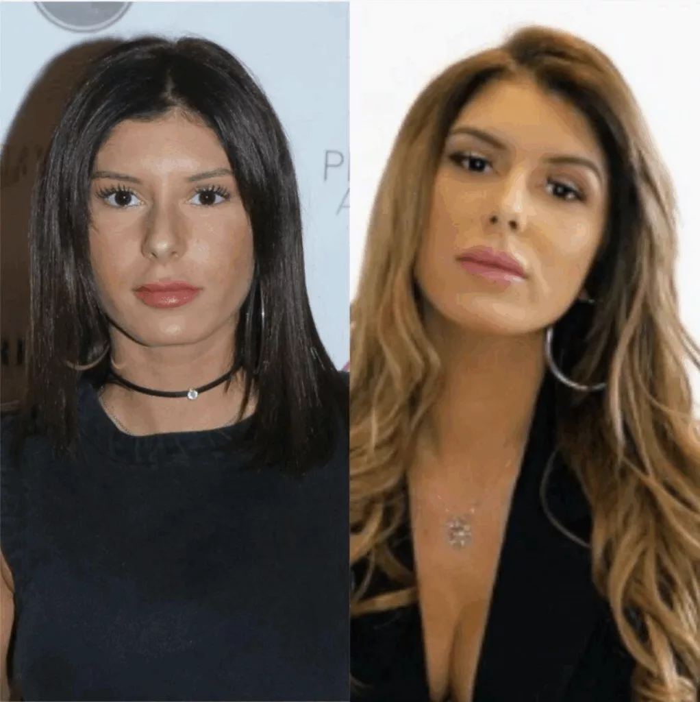 Photo de Laura Lempika en avant et arpès chirurgie esthétique
