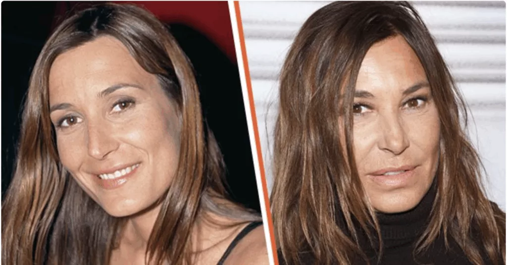 Photo de Zazie en avant et après chirurgie esthétique