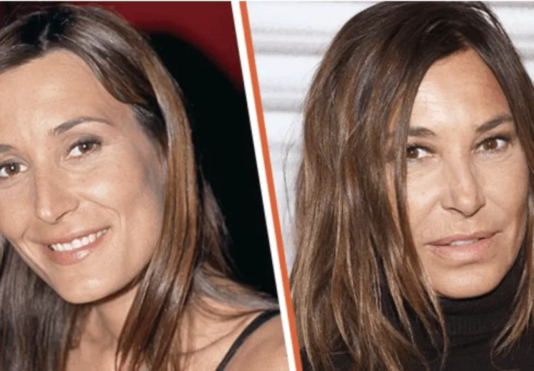 Photo de Zazie en avant et après chirurgie esthétique