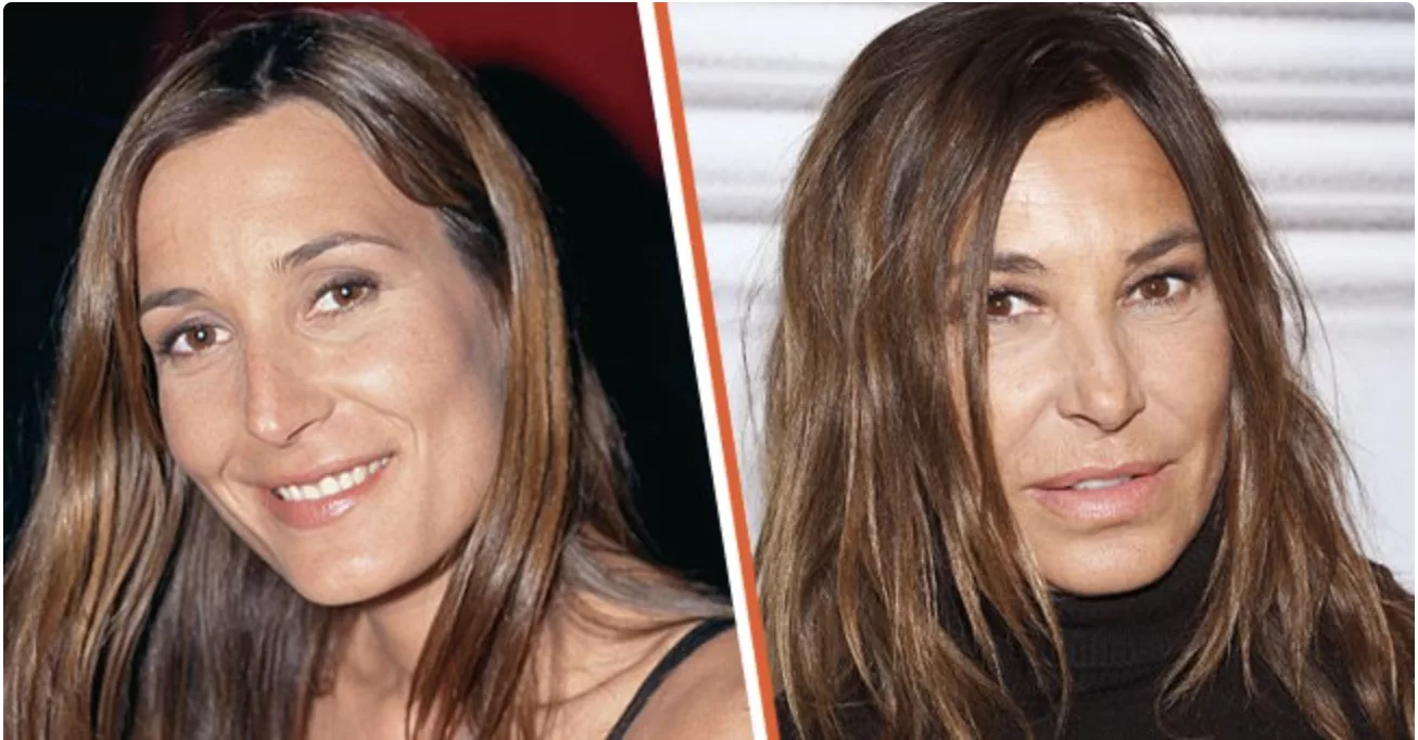 Photo de Zazie en avant et après chirurgie esthétique